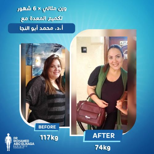 تجاربكم مع تكميم المعدة 2